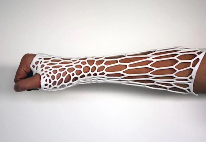 3d Printed alternative to plaster cast